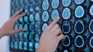 Què sap la població espanyola sobre l’Alzheimer? Les cinc falses creences més esteses